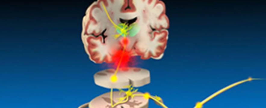 Module 4: Neuropathic pain: Identification and management.